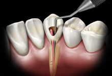 Endodonti Diş Tedavisi
